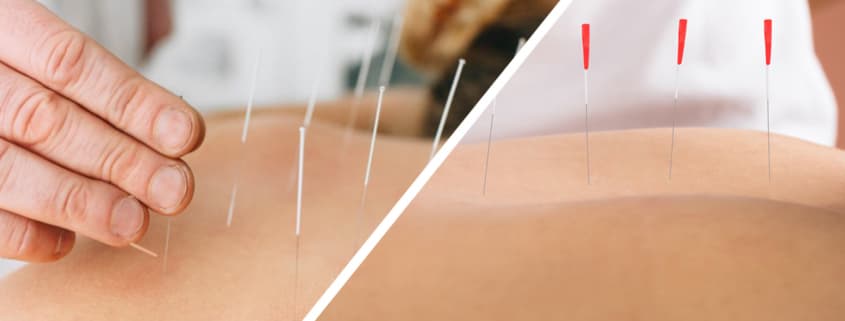 Dry Needling