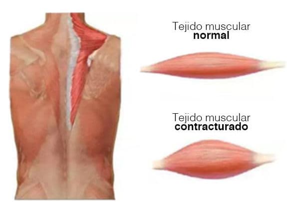 Cómo el estrés afecta al cuerpo y contribuye al dolor muscular